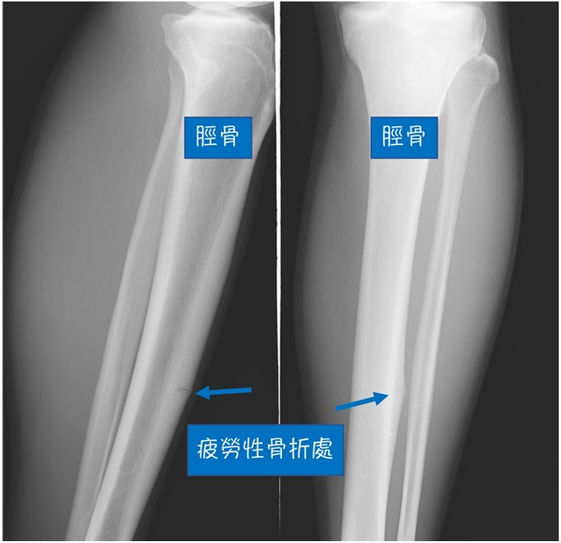 跑步後小腿痛 嚴重恐致 疲勞性骨折 3招伸展 放鬆肌肉的方式 康健雜誌