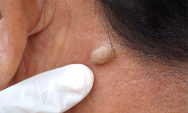 歌手脖子突起一顆憂淋巴出問題醫師 可能是表皮囊腫 康健雜誌