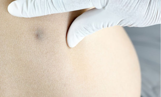 粉瘤是什麼 醫師剖析粉瘤原因和粉瘤手術方式 康健雜誌