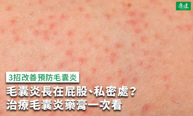 毛囊炎長在屁股 私密處 治療毛囊炎藥膏 3招改善 康健雜誌