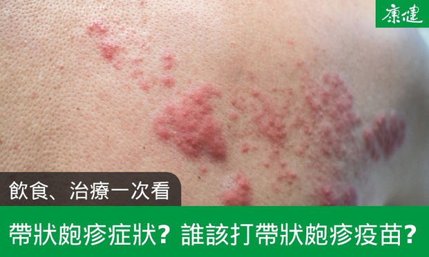 帶狀皰疹症狀是什麼 皮蛇會傳染 飲食 治療一次看 康健雜誌