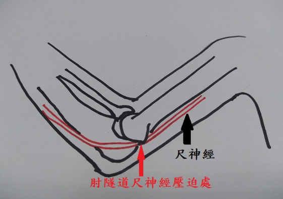 手肘疼痛就是網球肘 醫師 病因可以不單純 康健雜誌
