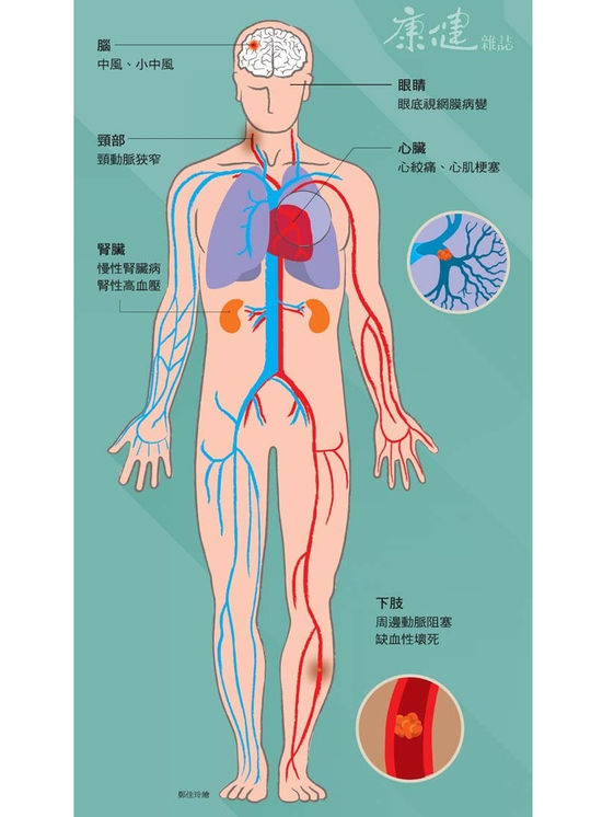 血管阻塞 全身遭殃 康健雜誌