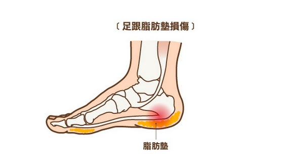 腳痛不一定是足底筋膜炎 蹠骨痛等5大足病要注意 康健雜誌